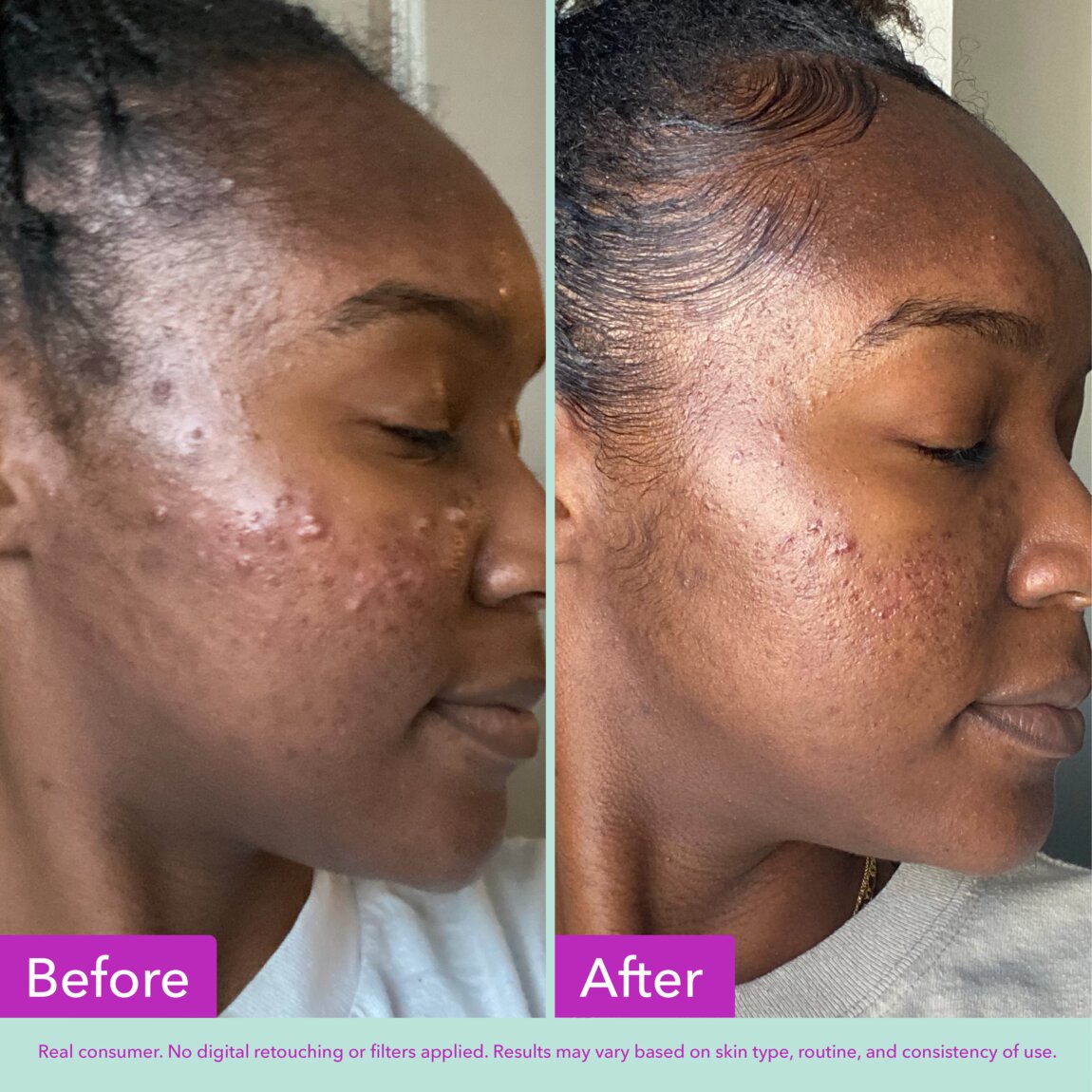 acne-foaming-cleanser-y6 zb_p.jpg